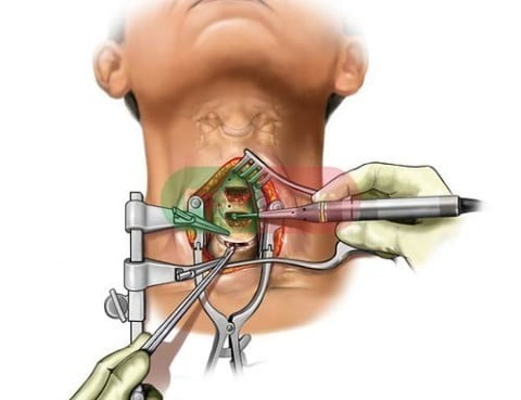 جراحی دیک گردن دیسککتومی قدامی