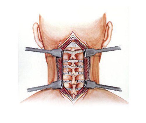 جراحی دیسک گردن دیسککتومی خلفی