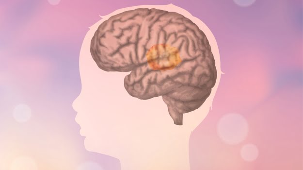 تومور مغزی در کودکان
