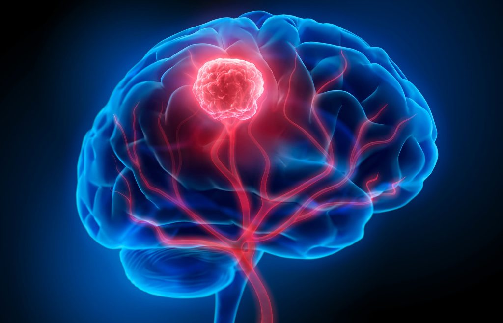 درمان متاستاتیک سرطان مغز