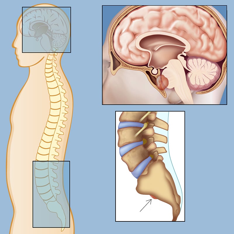 تومور کوردوما مغزی و ستون فقرات
