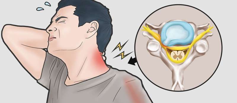 درمان بیروز زدگی دیسک گردن