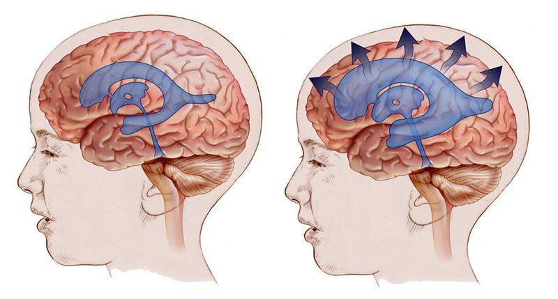 سودوتومور سربری یا تومور کاذب مغزی